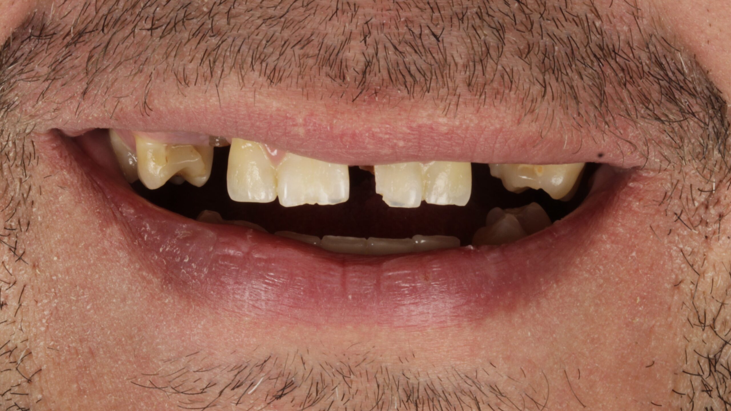 Case 46, double-arch All-on-4: smile before treatment by prosthodontist Dr. Esam Nahlah, Northern Virginia