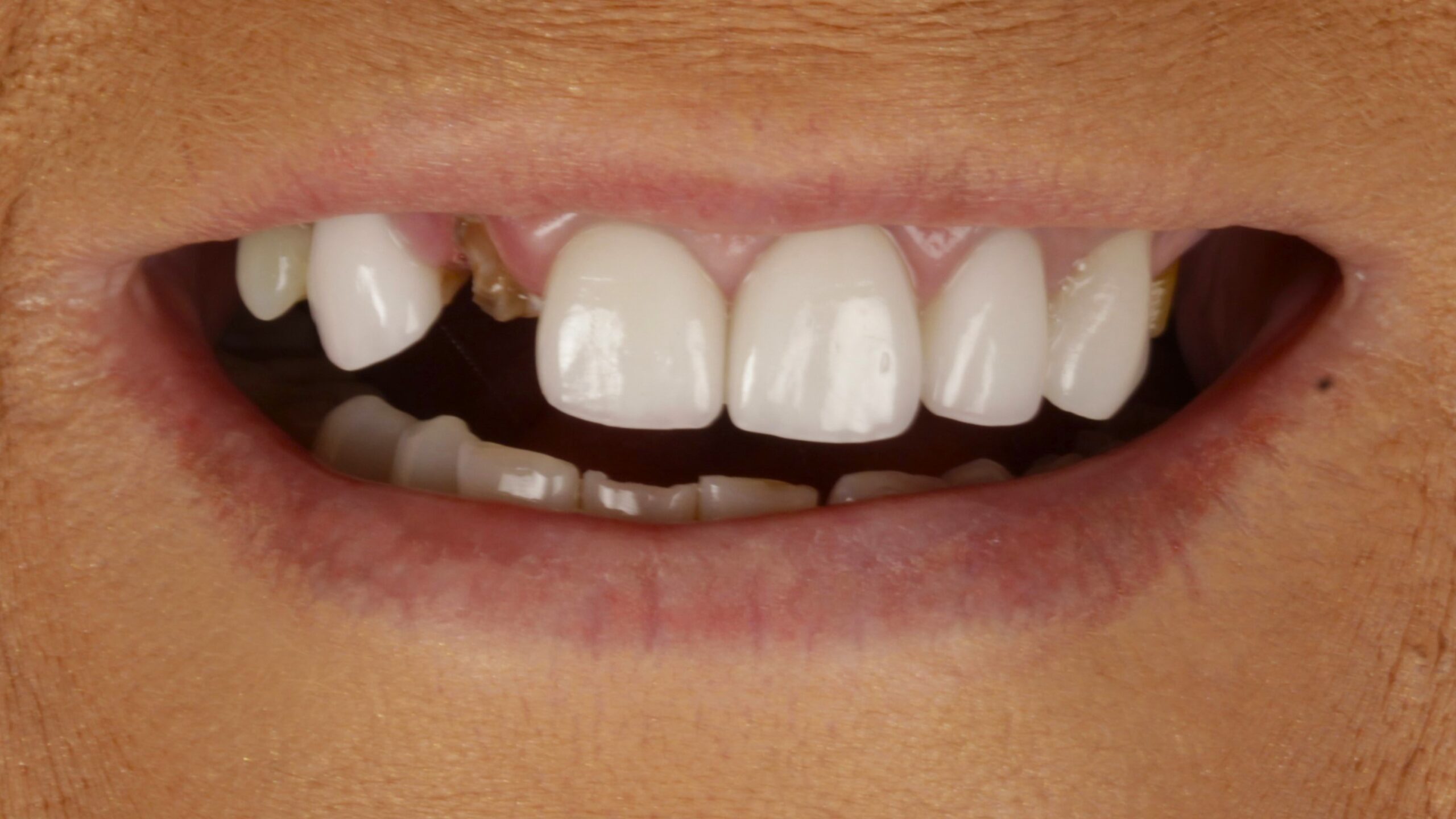 Case 28, double-arch All-on-4: smile before treatment by prosthodontist Dr. Esam Nahlah, Northern Virginia
