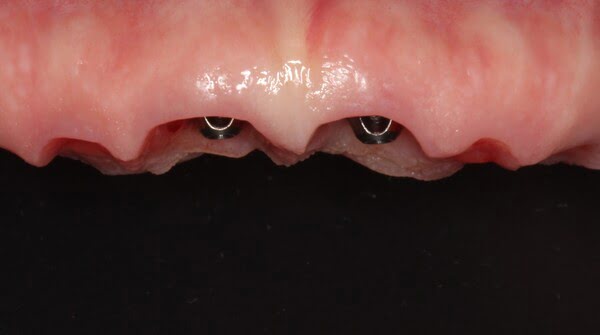 Case 11, All-on-4 dental implants: smile before treatment by prosthodontist Dr. Esam Nahlah, Northern Virginia