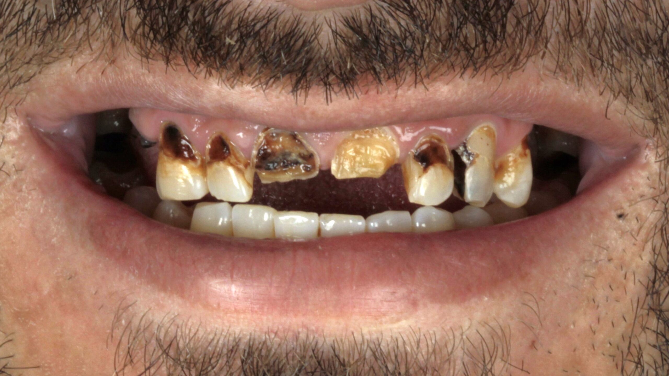 Patient smile before single-arch All-on-4