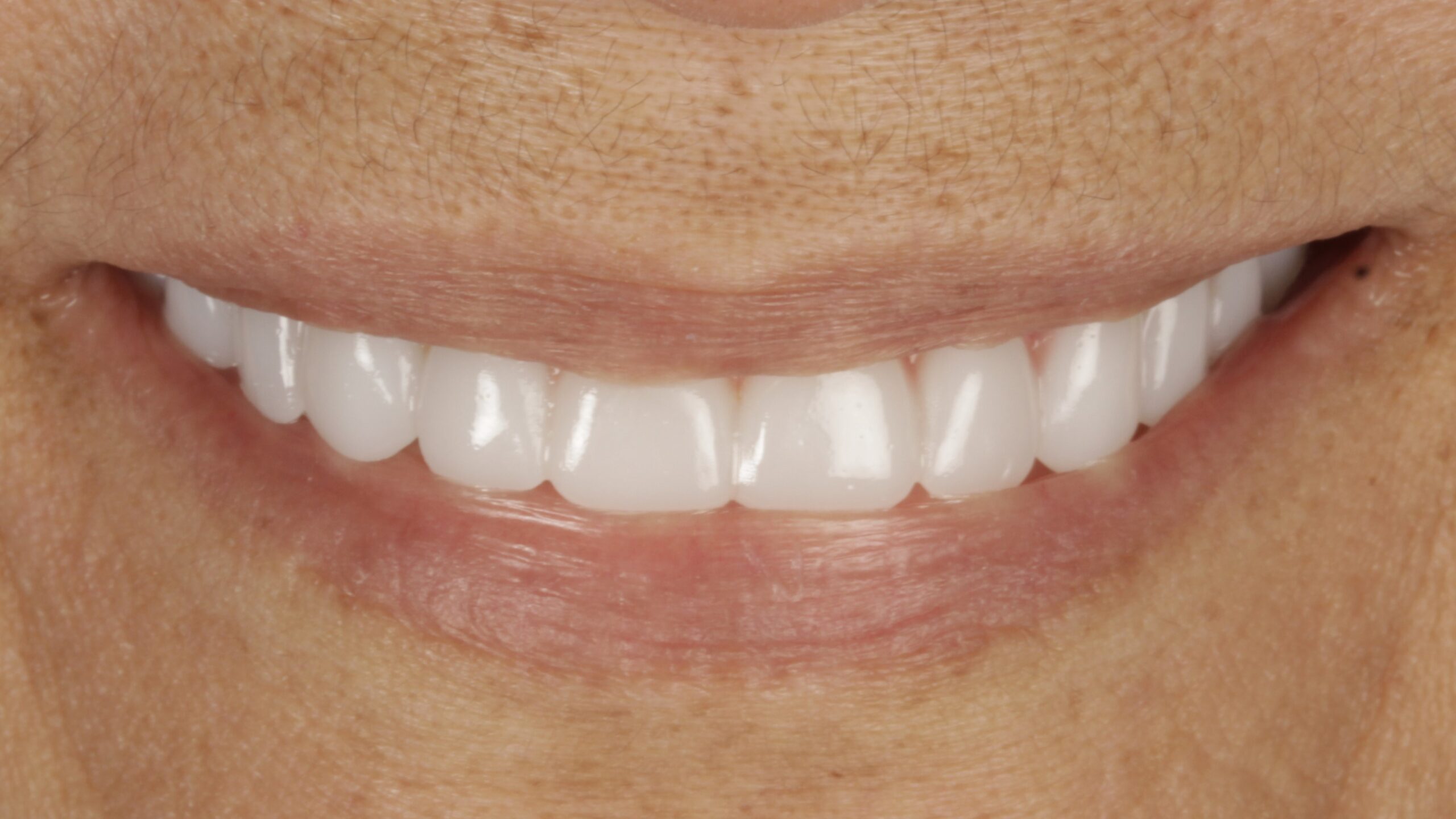 Both arches restored on implants