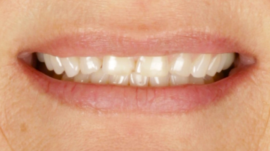 Case 34, porcelain veneers: smile before treatment by prosthodontist Dr. Esam Nahlah, Northern Virginia