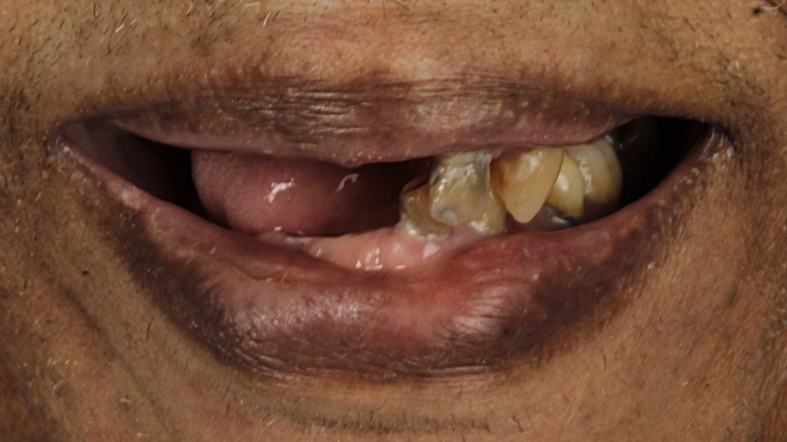 Case 31, double-arch All-on-4: smile before treatment by prosthodontist Dr. Esam Nahlah, Northern Virginia