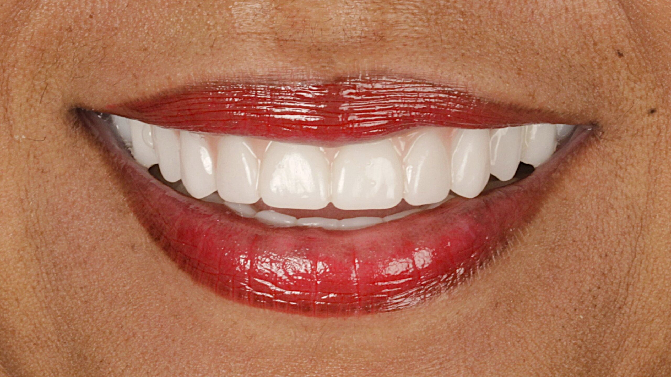 A completed double-arch implant restoration