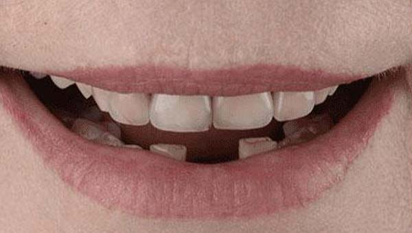 Case 18, porcelain veneers: smile before treatment by prosthodontist Dr. Esam Nahlah, Northern Virginia