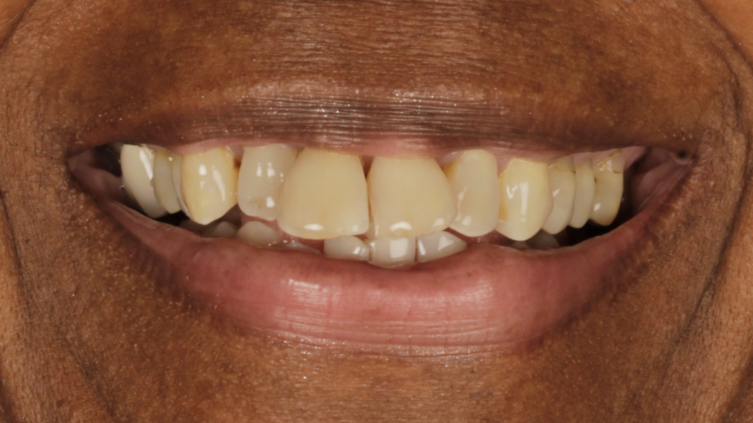 Case 44, veneers and implants: smile before treatment by prosthodontist Dr. Esam Nahlah, Northern Virginia