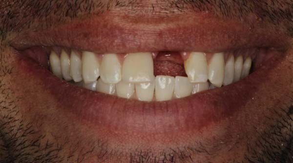 Case 12, full-mouth reconstruction: smile before treatment by prosthodontist Dr. Esam Nahlah, Northern Virginia