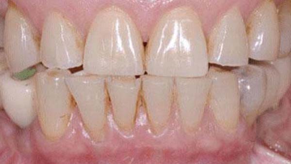 Case 16, smile makeover: smile before treatment by prosthodontist Dr. Esam Nahlah, Northern Virginia
