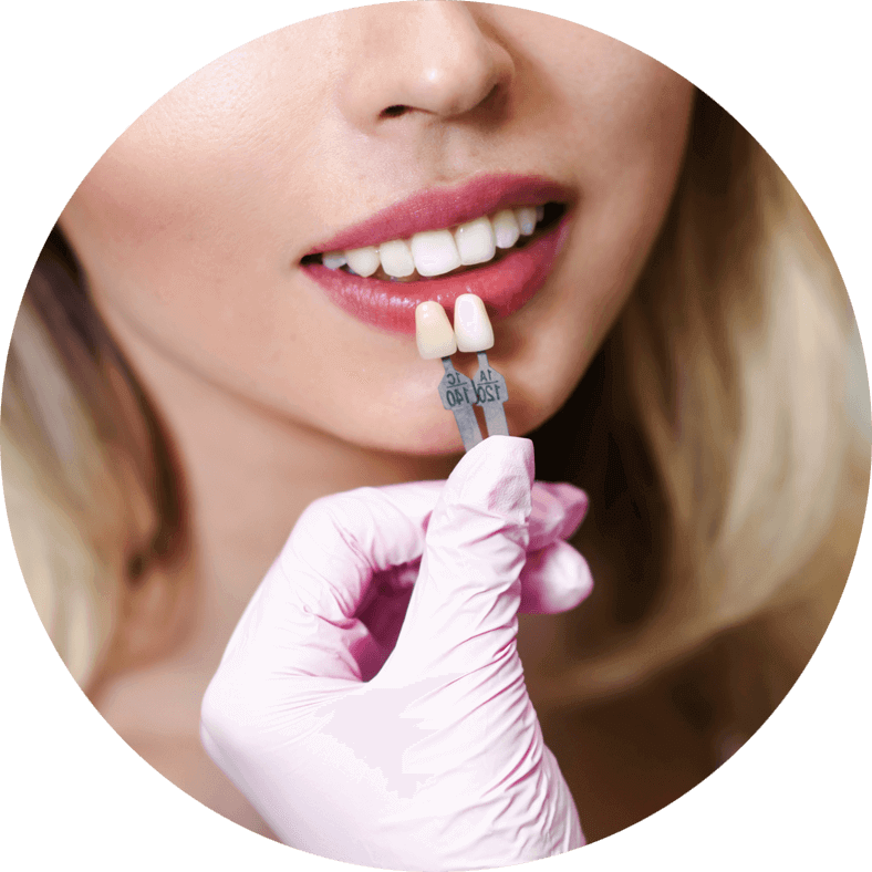 A shade guide held against a patient's smile to match veneer colour