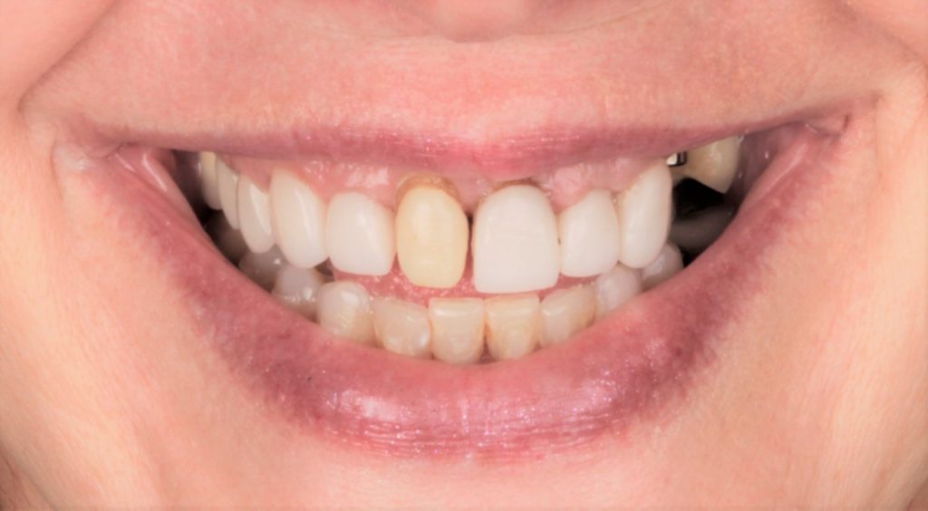 Case 4, full-mouth reconstruction: smile before treatment by prosthodontist Dr. Esam Nahlah, Northern Virginia