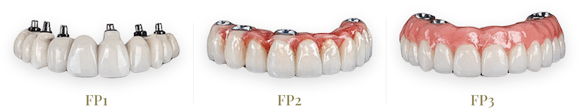 FP1, FP2 and FP3 full-arch prostheses side by side