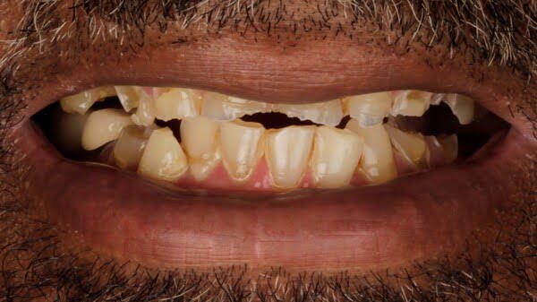 Case 7, All-on-4 dental implants: smile before treatment by prosthodontist Dr. Esam Nahlah, Northern Virginia