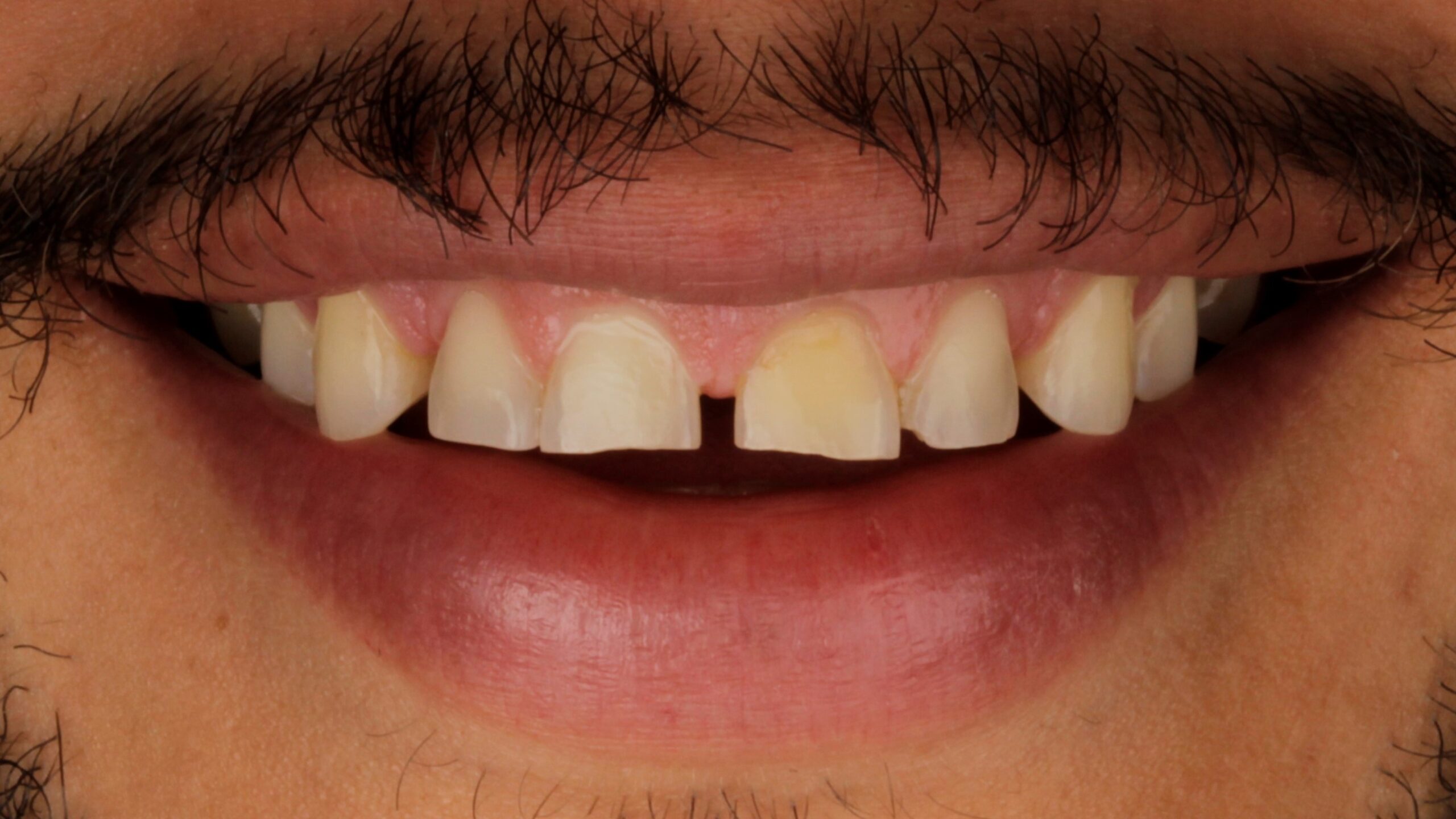 Case 35, porcelain veneers: smile before treatment by prosthodontist Dr. Esam Nahlah, Northern Virginia