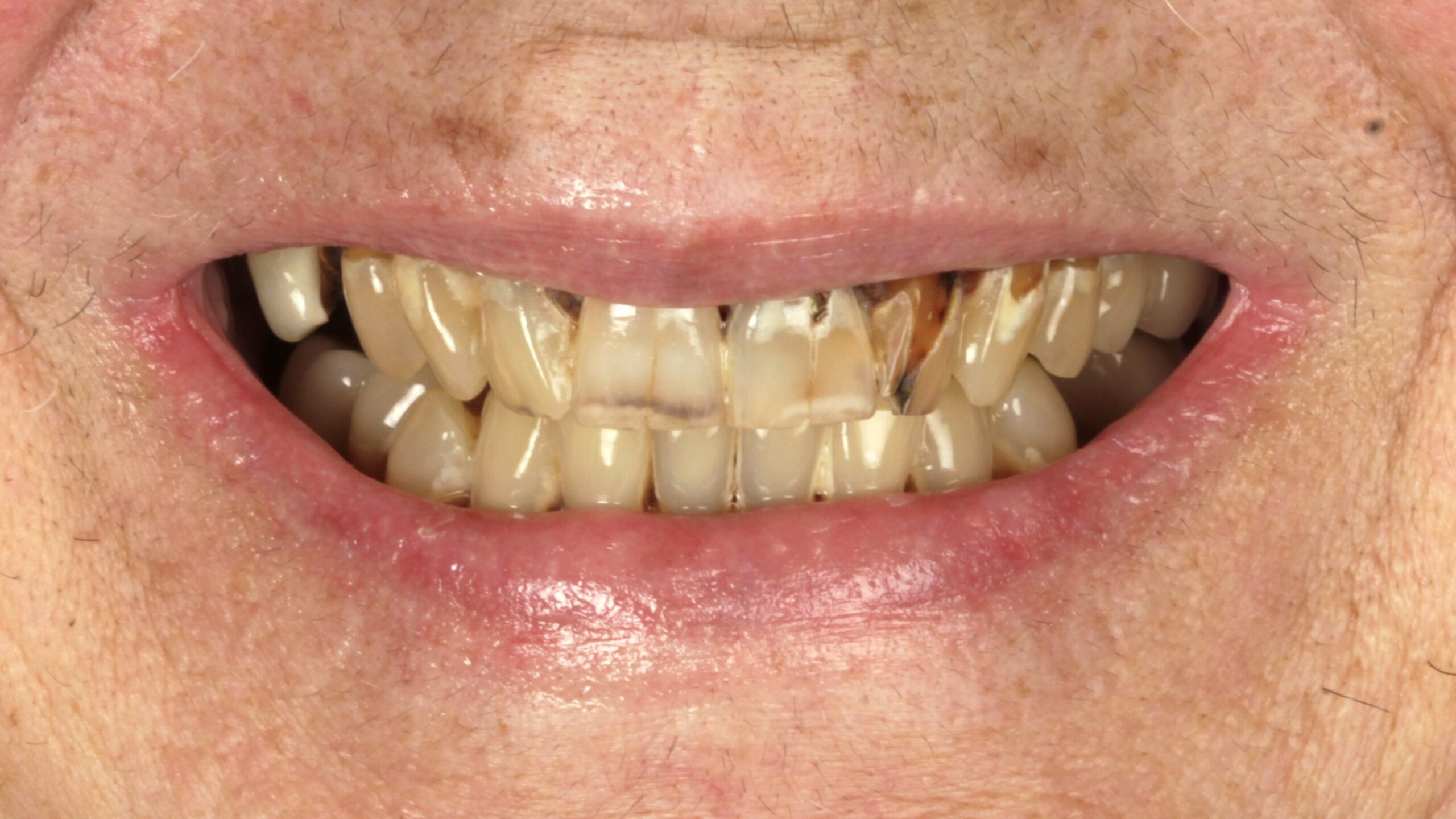 Case 24, double-arch All-on-4: smile before treatment by prosthodontist Dr. Esam Nahlah, Northern Virginia