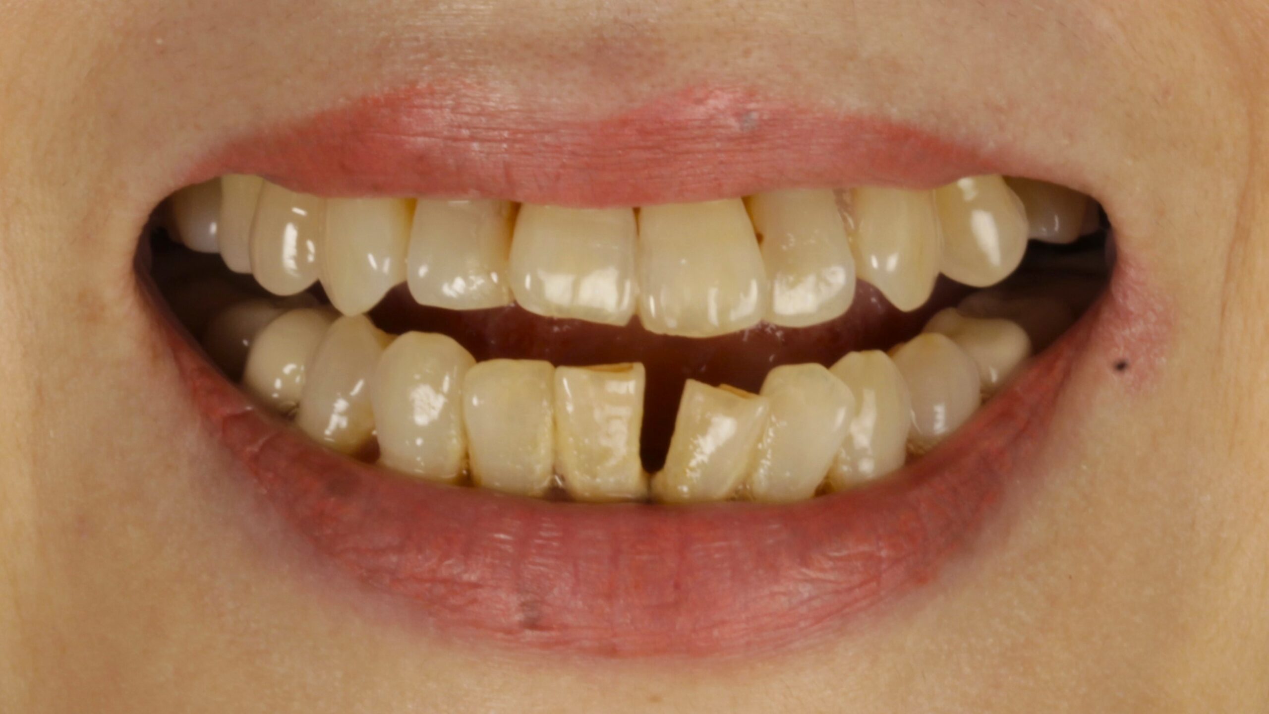 Case 32, double-arch All-on-4: smile before treatment by prosthodontist Dr. Esam Nahlah, Northern Virginia