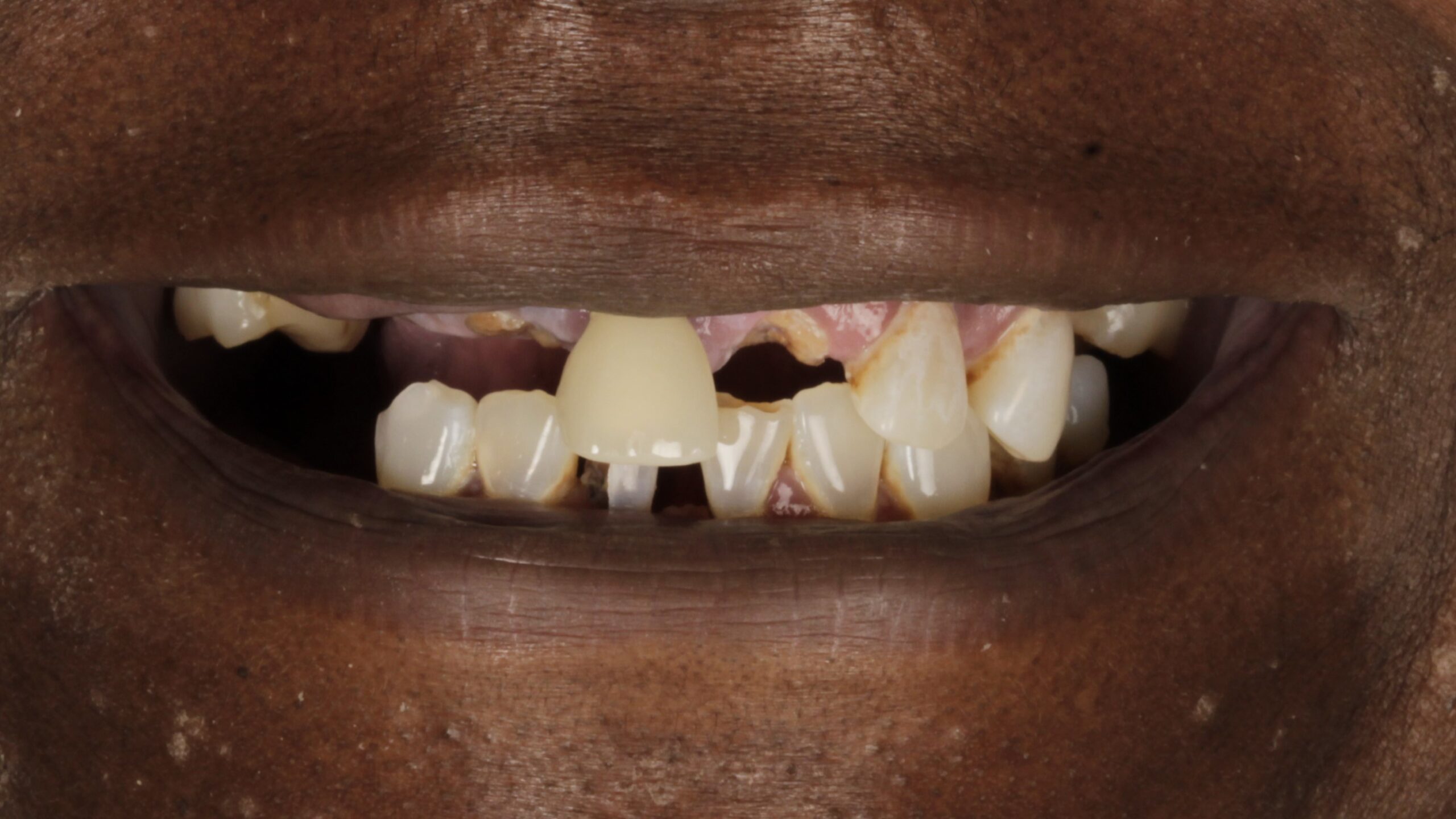 Case 30, double-arch All-on-4: smile before treatment by prosthodontist Dr. Esam Nahlah, Northern Virginia