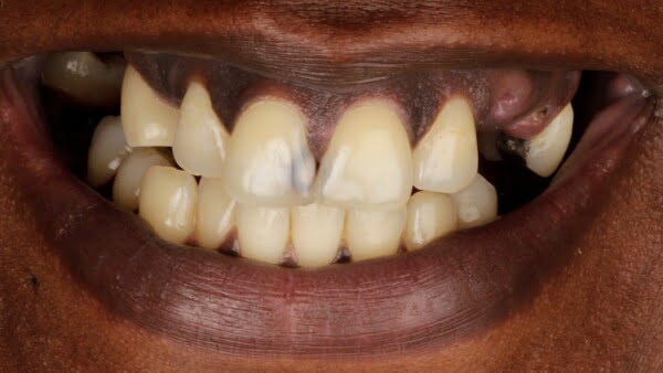 Case 6, All-on-4 dental implants: smile before treatment by prosthodontist Dr. Esam Nahlah, Northern Virginia