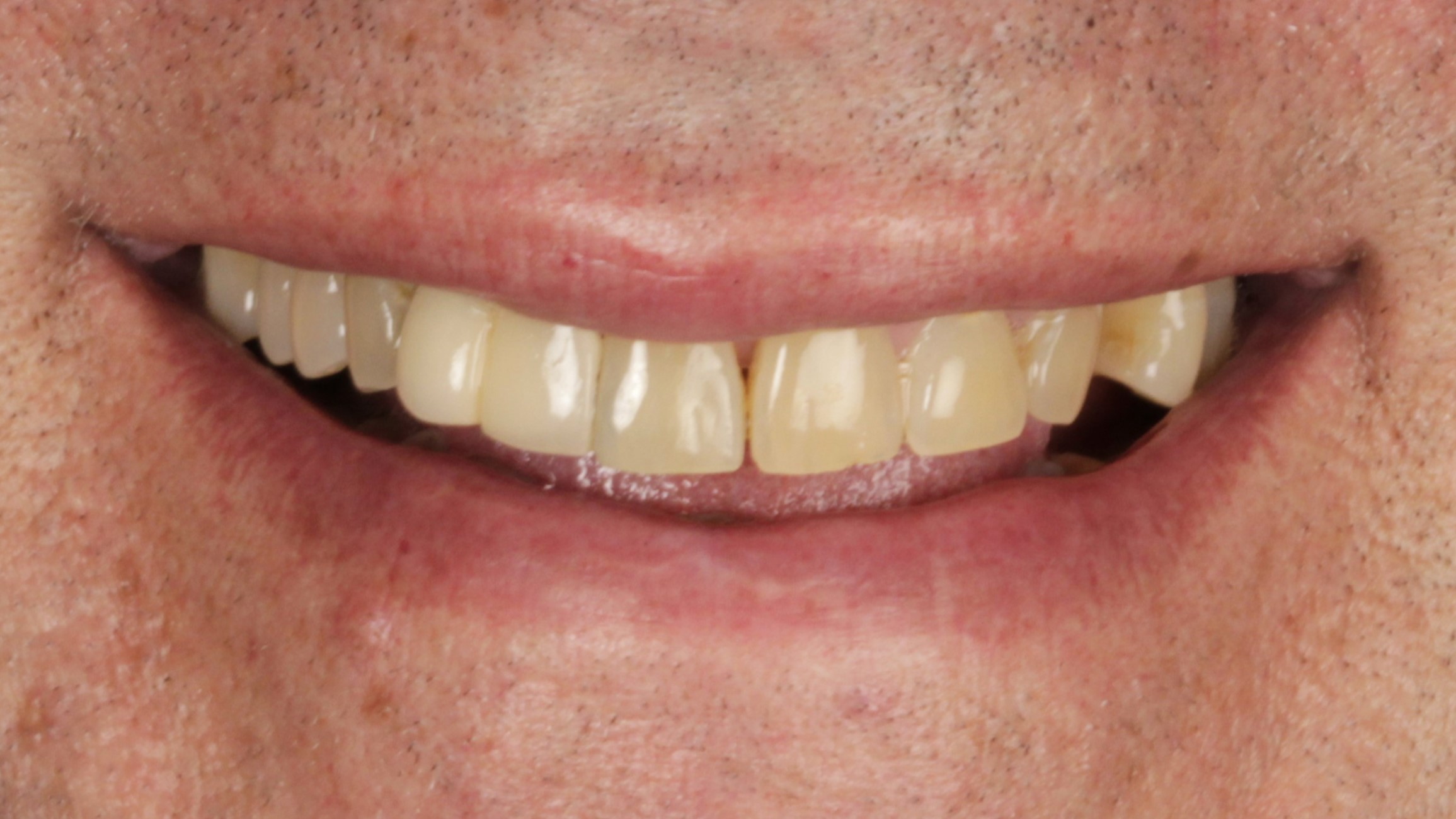 Before: veneers and implant restoration case