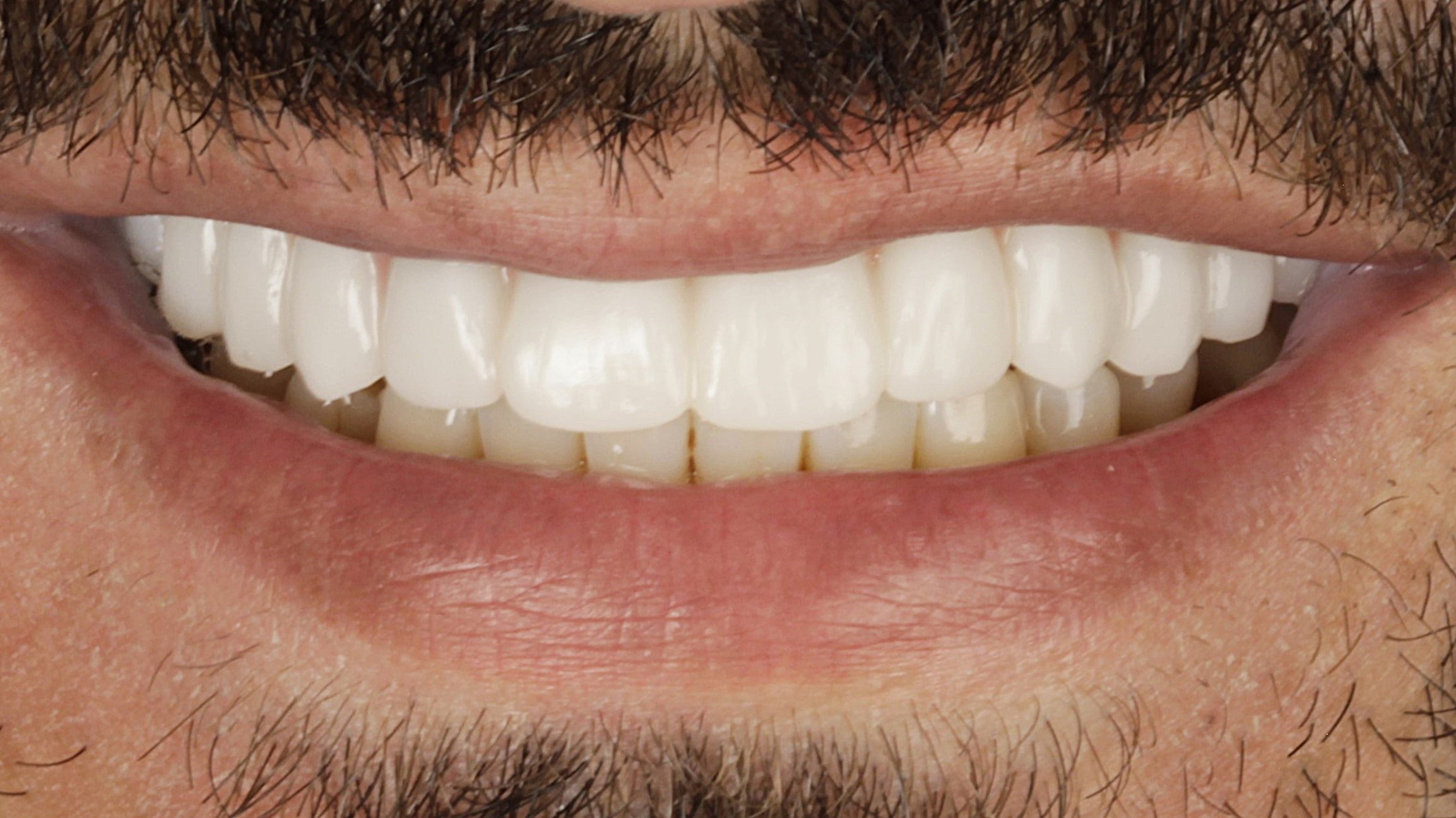The same smile after single-arch All-on-4