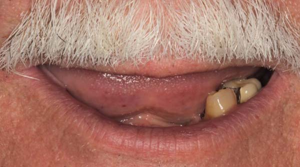Case 8, full-mouth reconstruction: smile before treatment by prosthodontist Dr. Esam Nahlah, Northern Virginia