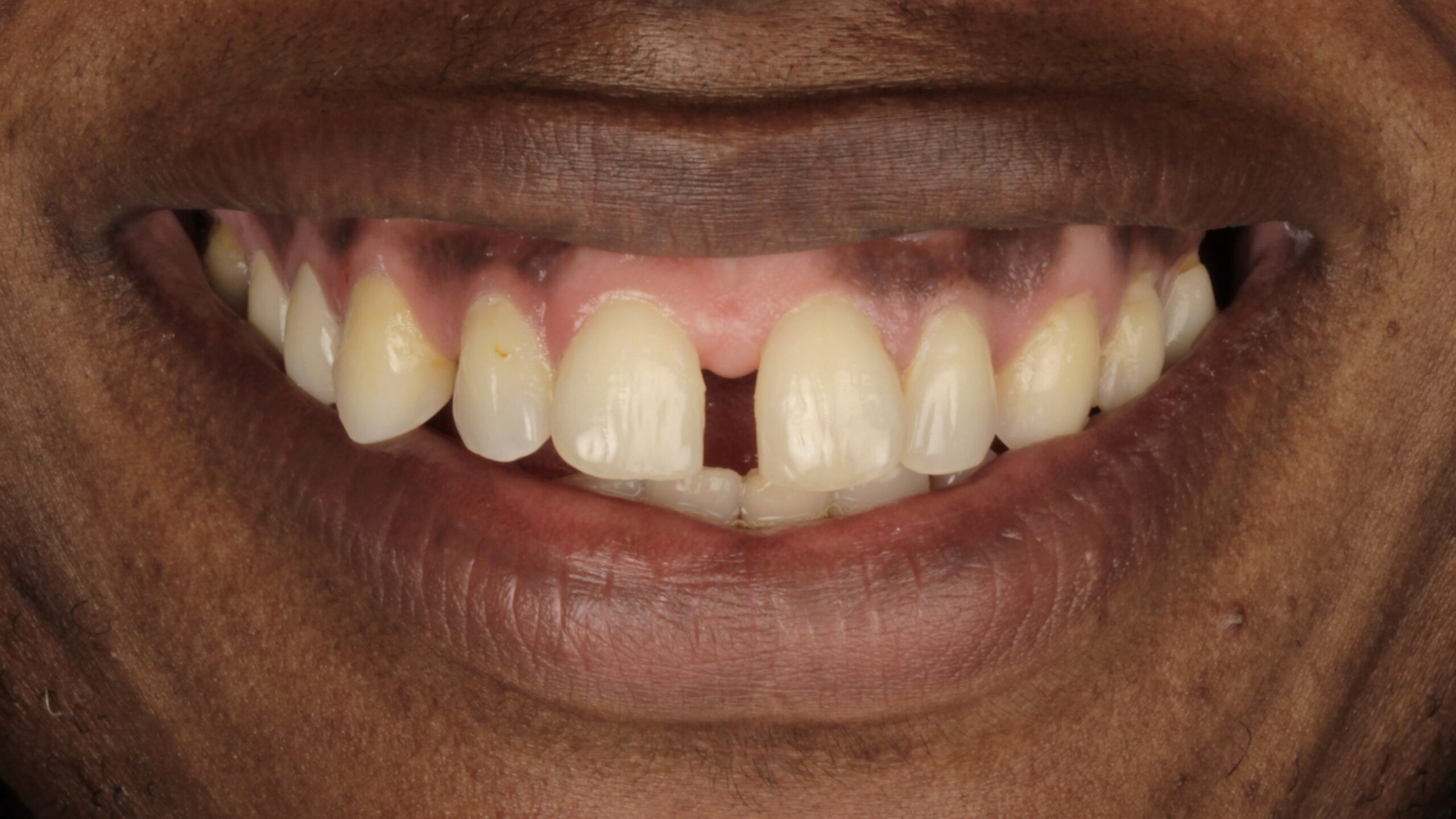 Case 38, porcelain veneers: smile before treatment by prosthodontist Dr. Esam Nahlah, Northern Virginia