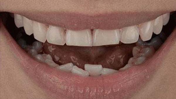 Case 13, porcelain veneers: smile before treatment by prosthodontist Dr. Esam Nahlah, Northern Virginia