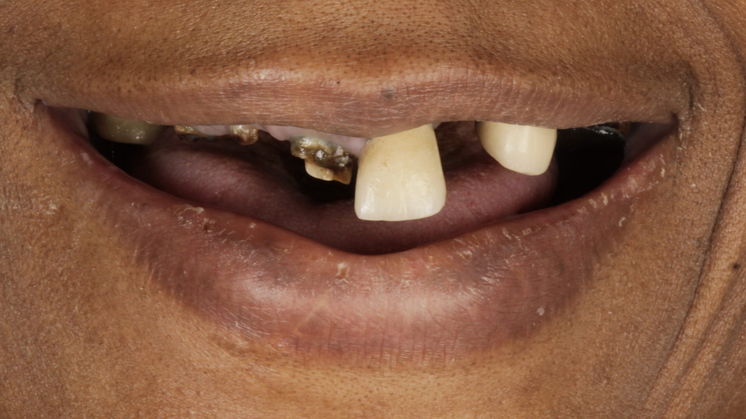 Case 23, double-arch All-on-4: smile before treatment by prosthodontist Dr. Esam Nahlah, Northern Virginia