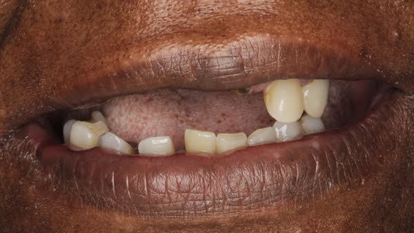Case 1, All-on-4 dental implants: smile before treatment by prosthodontist Dr. Esam Nahlah, Northern Virginia