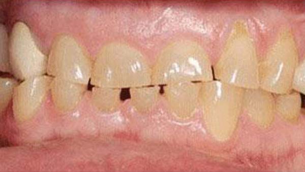 Case 17, porcelain veneers: smile before treatment by prosthodontist Dr. Esam Nahlah, Northern Virginia
