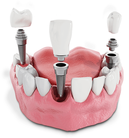 A restoration seated on implants
