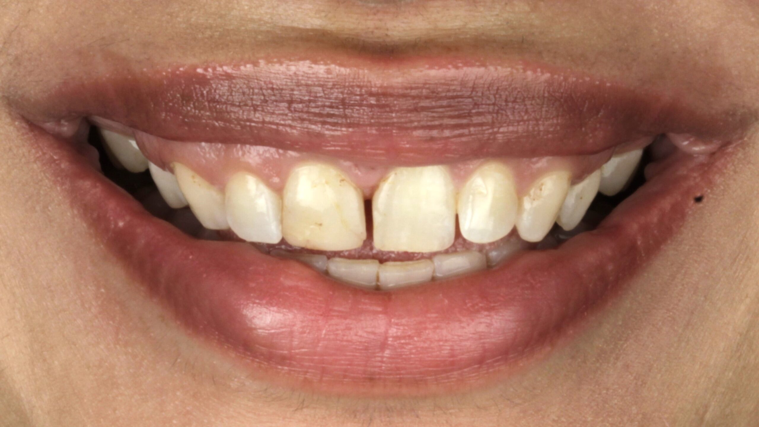 Case 39, porcelain veneers: smile before treatment by prosthodontist Dr. Esam Nahlah, Northern Virginia