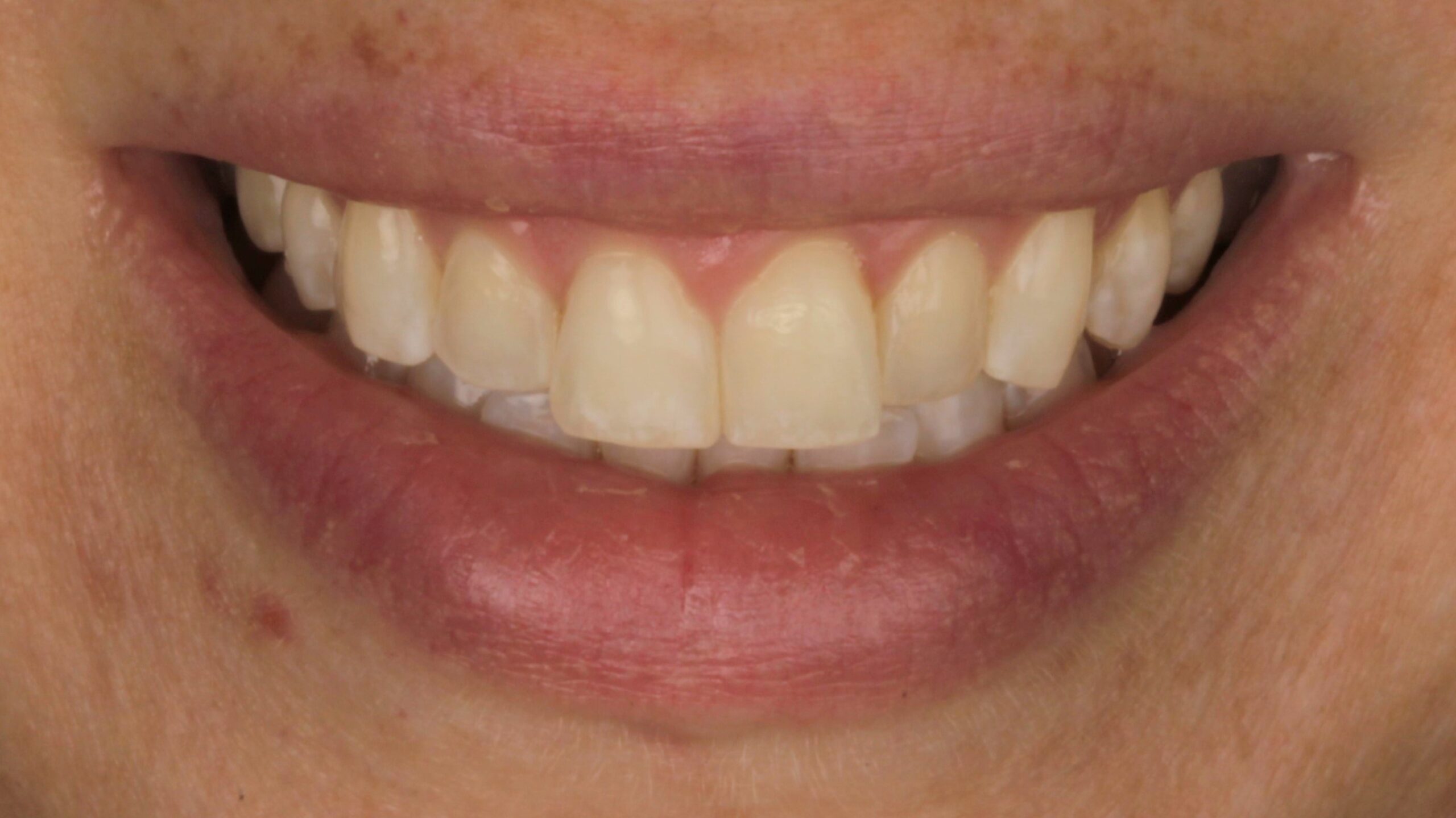 Case 40, porcelain veneers: smile before treatment by prosthodontist Dr. Esam Nahlah, Northern Virginia
