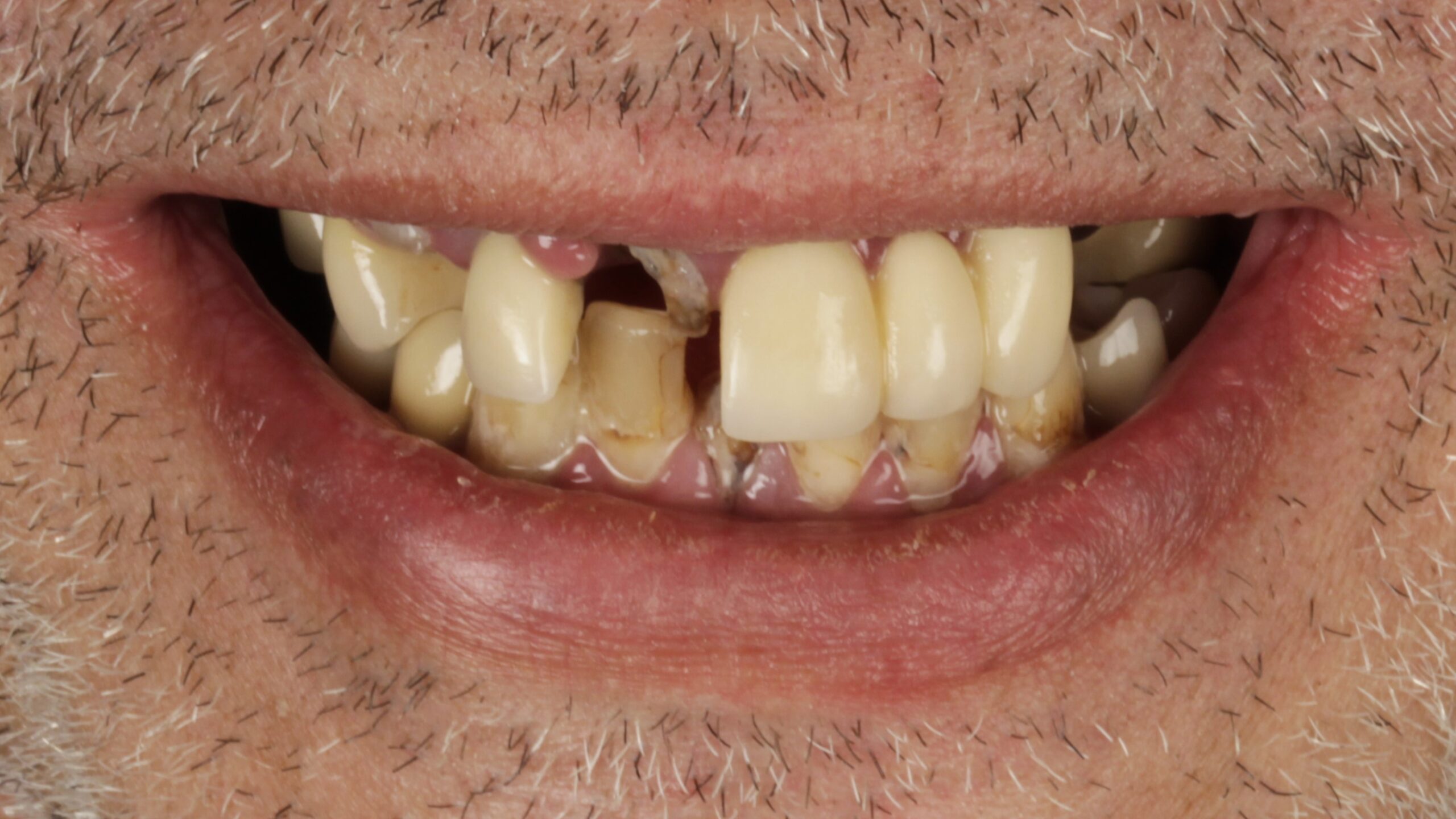 Case 21, double-arch All-on-4: smile before treatment by prosthodontist Dr. Esam Nahlah, Northern Virginia