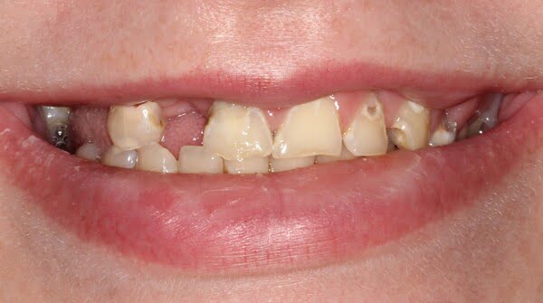 Case 10, All-on-4 dental implants: smile before treatment by prosthodontist Dr. Esam Nahlah, Northern Virginia