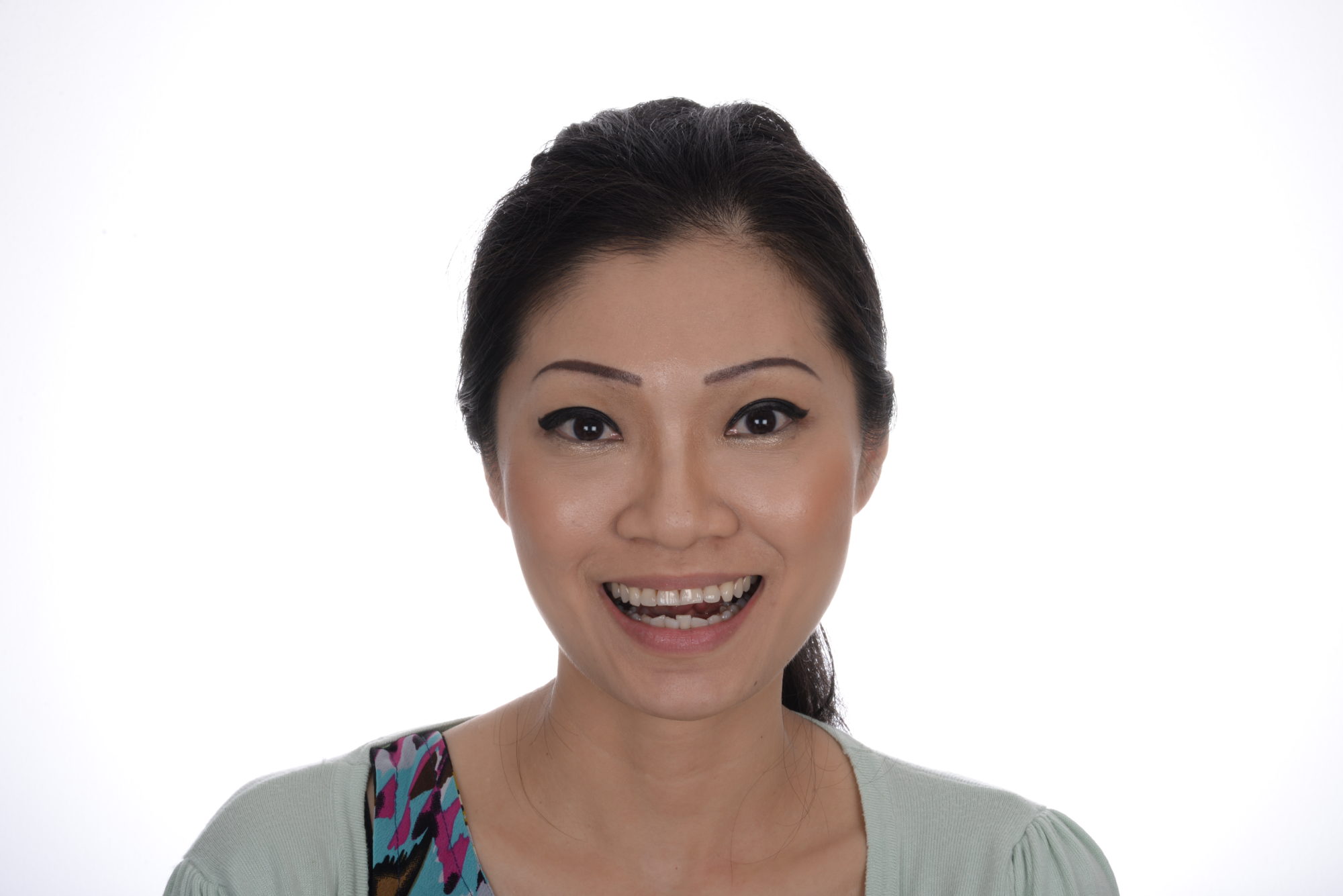 Case 47, smile makeover: smile before treatment by prosthodontist Dr. Esam Nahlah, Northern Virginia