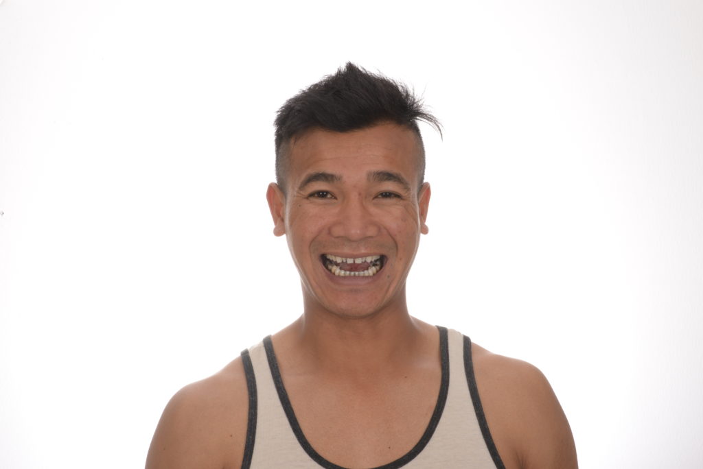 Case 48, smile makeover: smile before treatment by prosthodontist Dr. Esam Nahlah, Northern Virginia