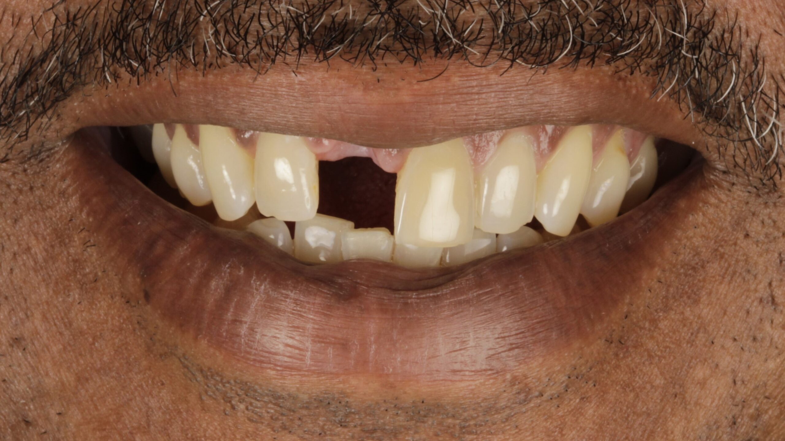 Case 45, veneers and implants: smile before treatment by prosthodontist Dr. Esam Nahlah, Northern Virginia