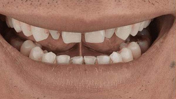 Case 14, porcelain veneers: smile before treatment by prosthodontist Dr. Esam Nahlah, Northern Virginia