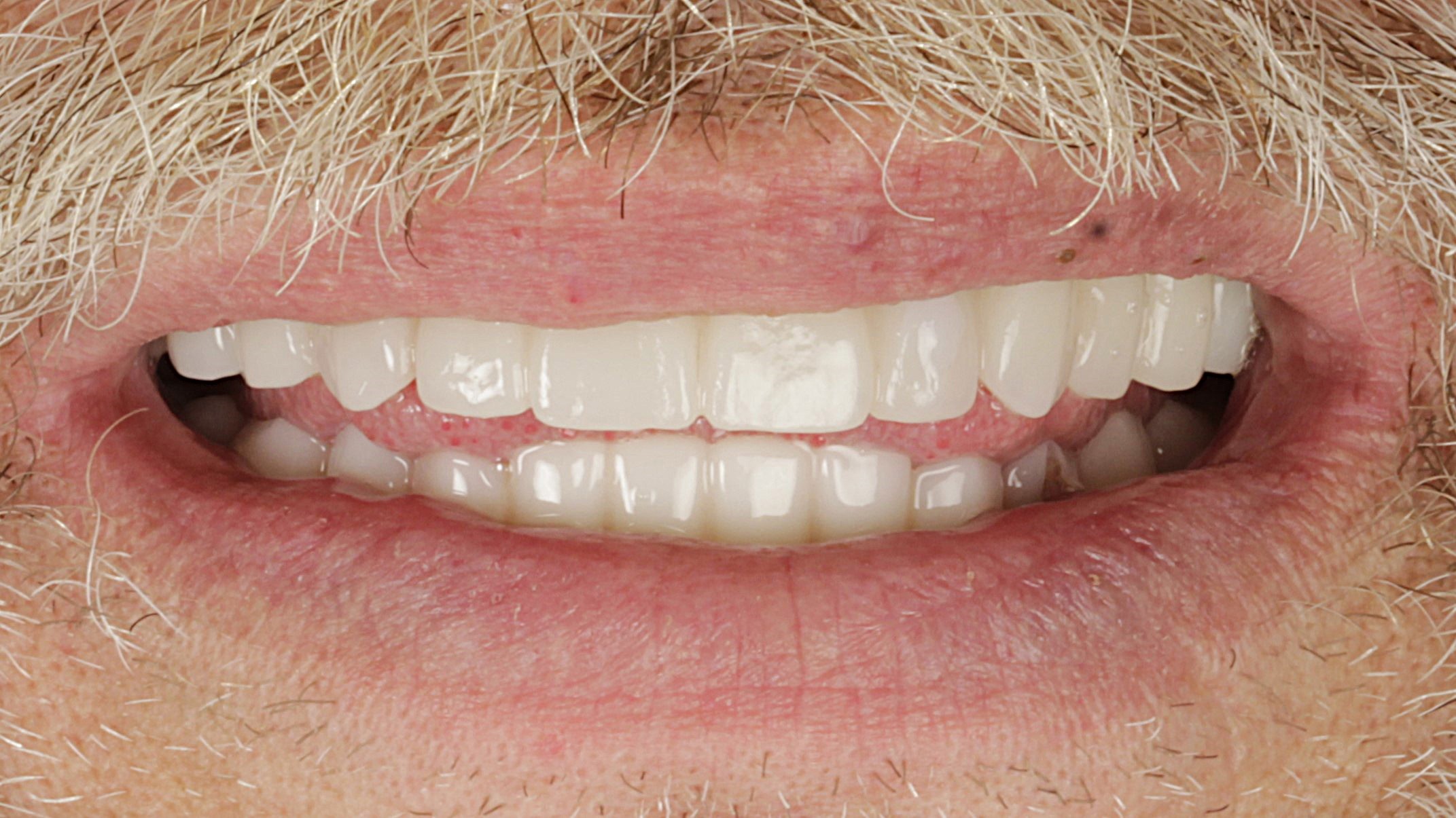 The same smile after double-arch All-on-4