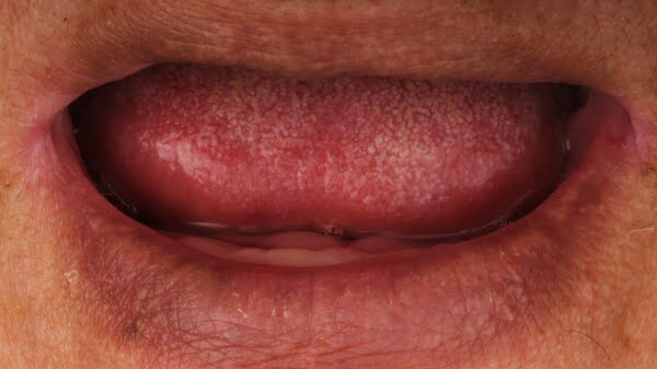 Case 5, All-on-4 dental implants: smile before treatment by prosthodontist Dr. Esam Nahlah, Northern Virginia