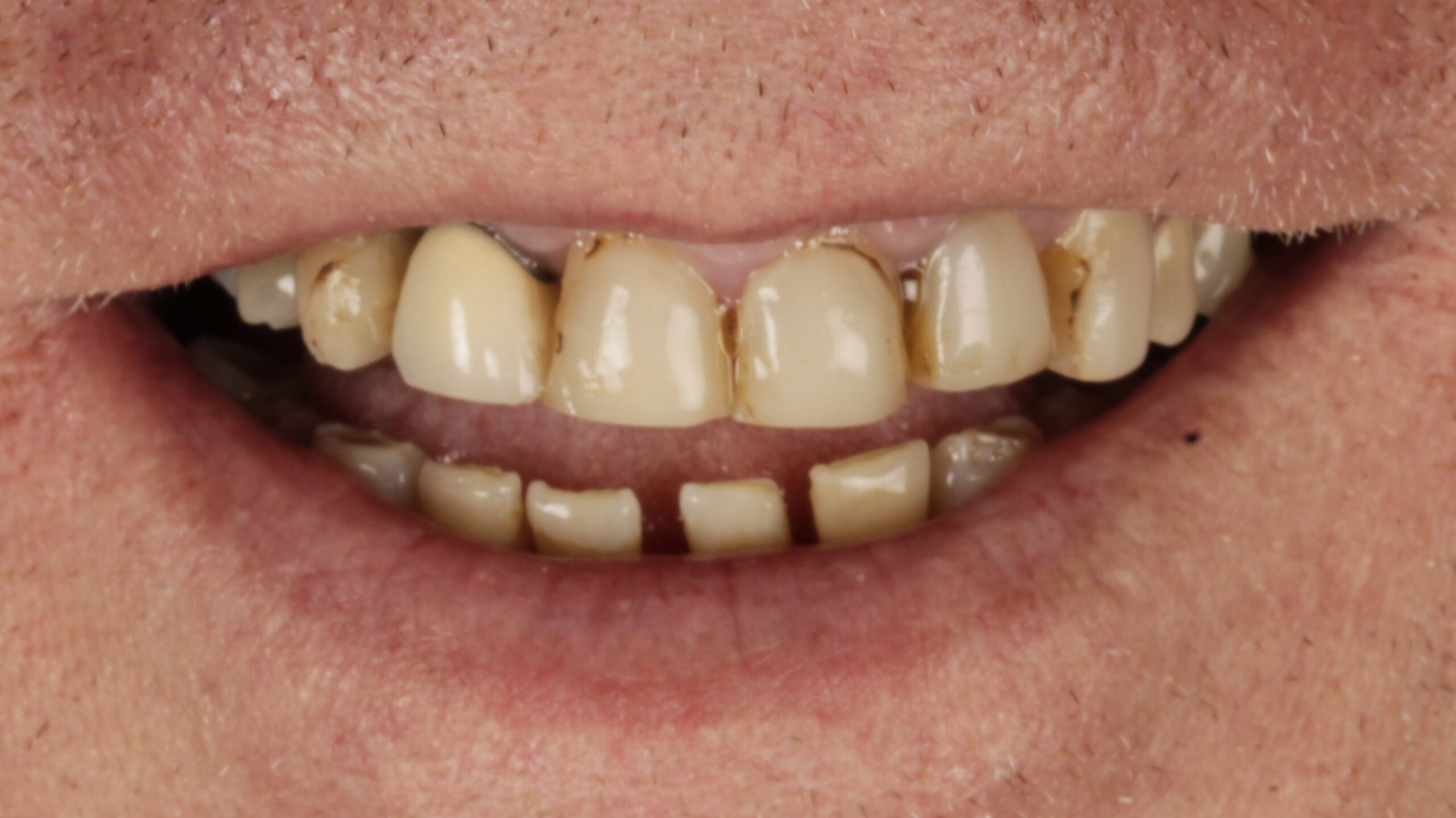 Case 27, double-arch All-on-4: smile before treatment by prosthodontist Dr. Esam Nahlah, Northern Virginia