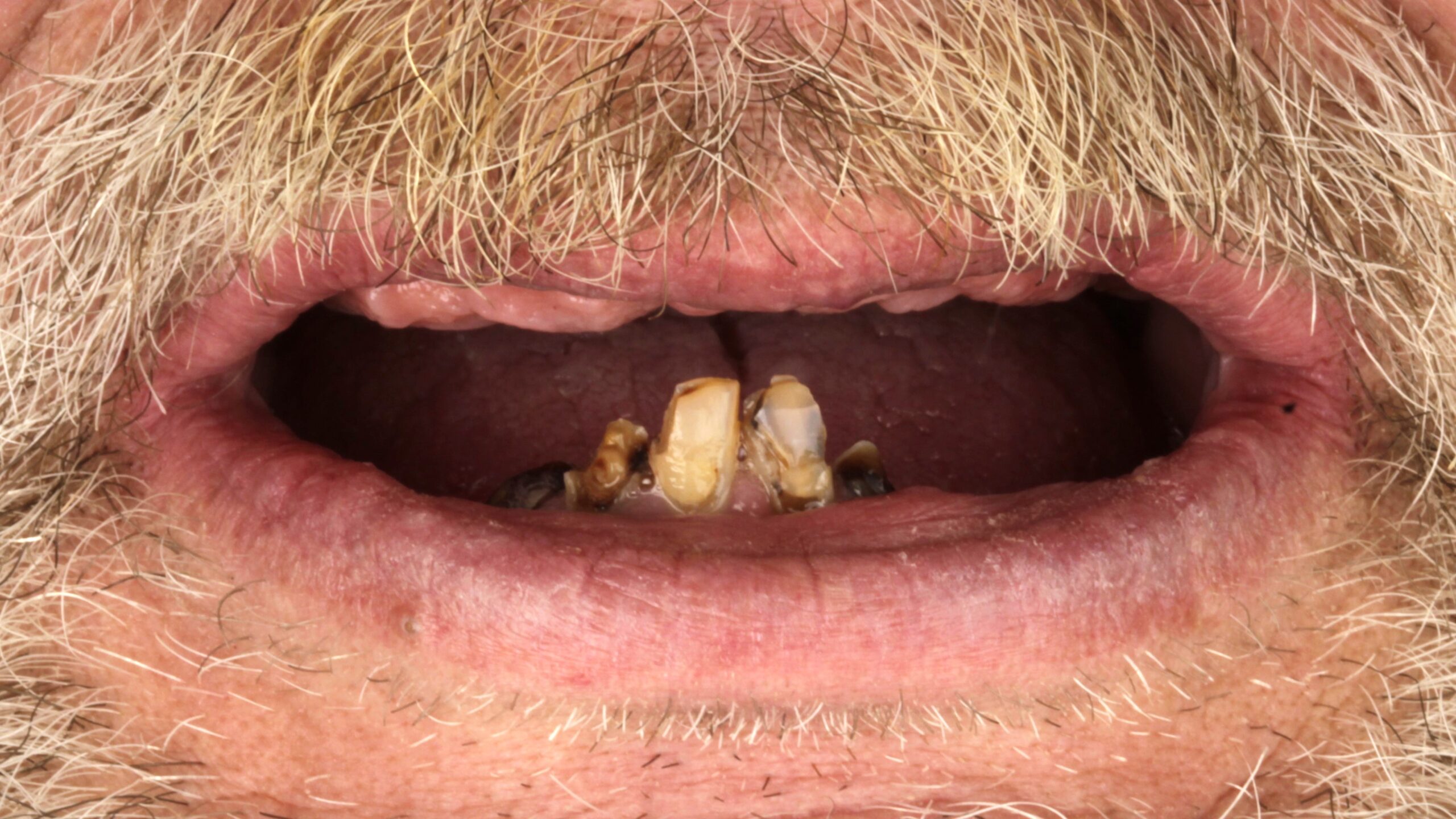 Patient smile before double-arch All-on-4