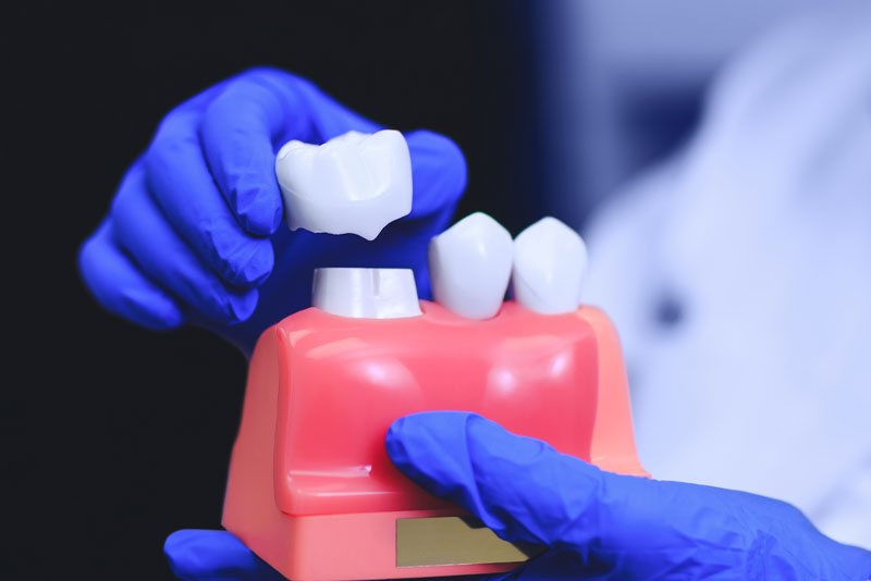 A crown being seated onto a demonstration model
