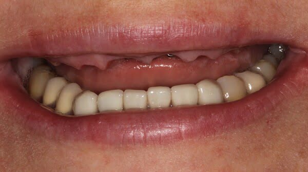 Case 3, All-on-4 dental implants: smile before treatment by prosthodontist Dr. Esam Nahlah, Northern Virginia
