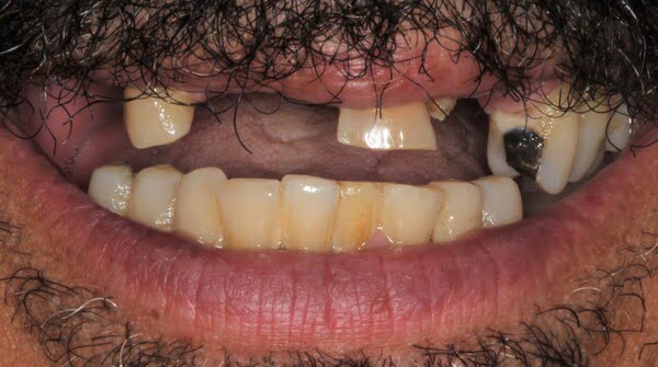 Case 2, All-on-4 dental implants: smile before treatment by prosthodontist Dr. Esam Nahlah, Northern Virginia