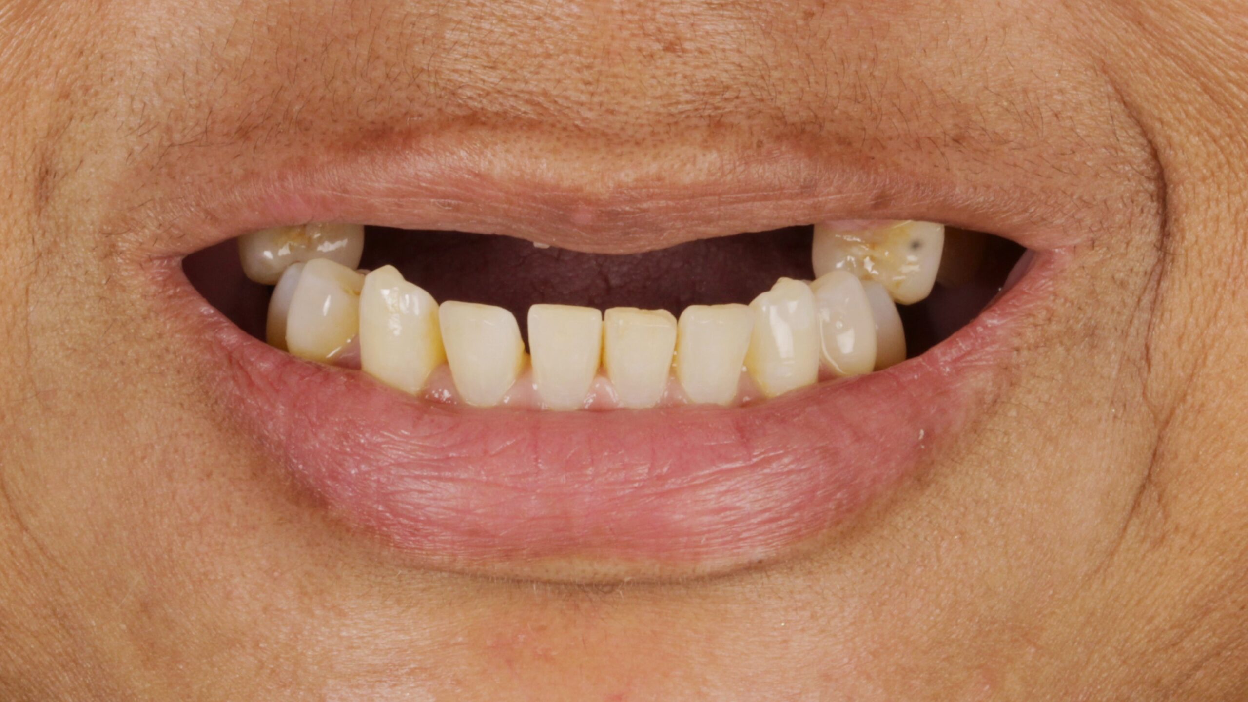 Case 22, double-arch All-on-4: smile before treatment by prosthodontist Dr. Esam Nahlah, Northern Virginia
