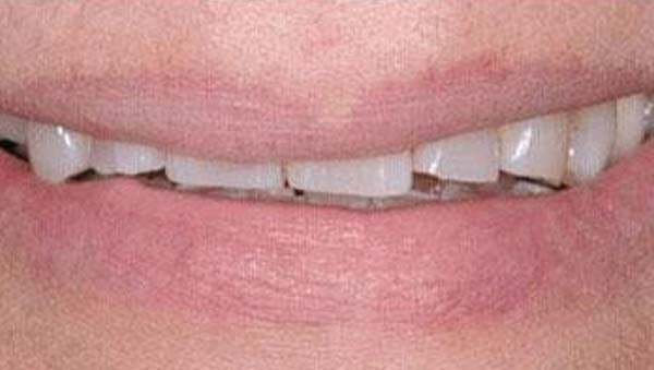 Case 20, smile makeover: smile before treatment by prosthodontist Dr. Esam Nahlah, Northern Virginia