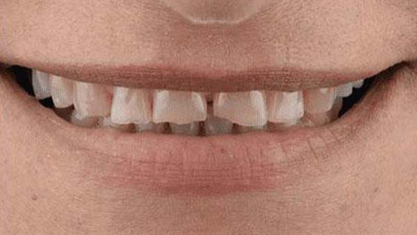 Case 15, porcelain veneers: smile before treatment by prosthodontist Dr. Esam Nahlah, Northern Virginia