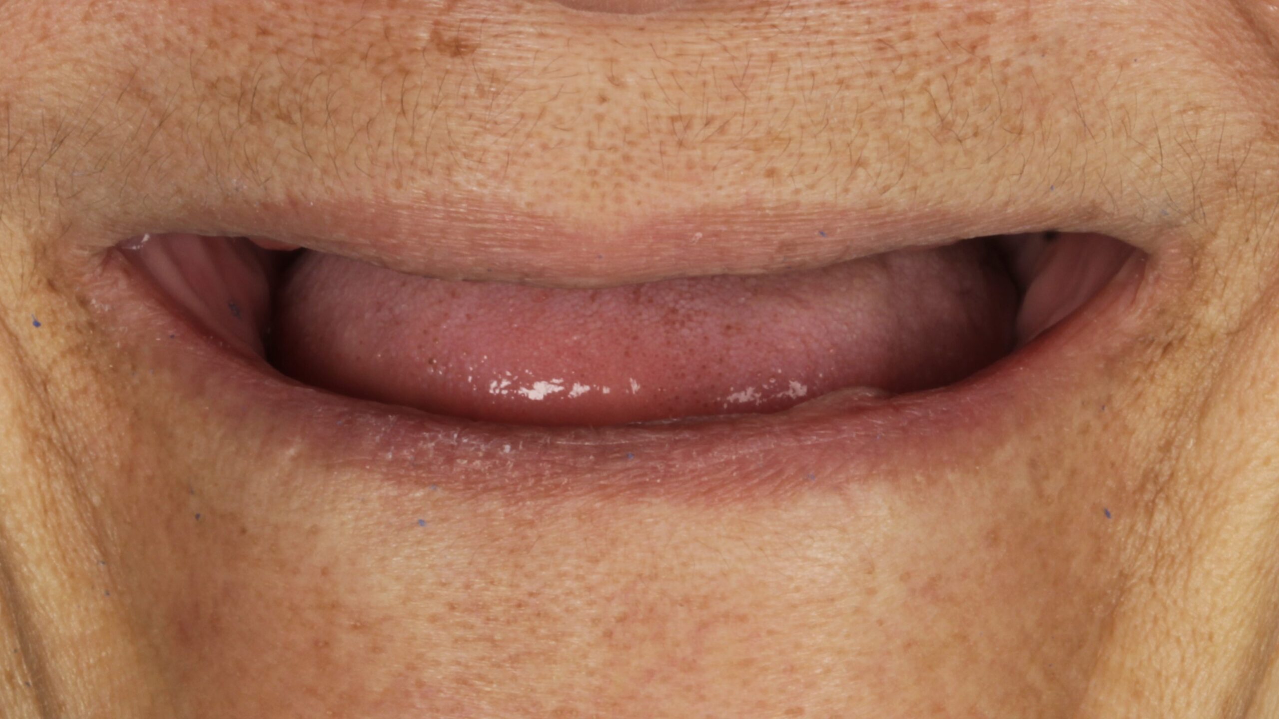 Both arches failing before treatment