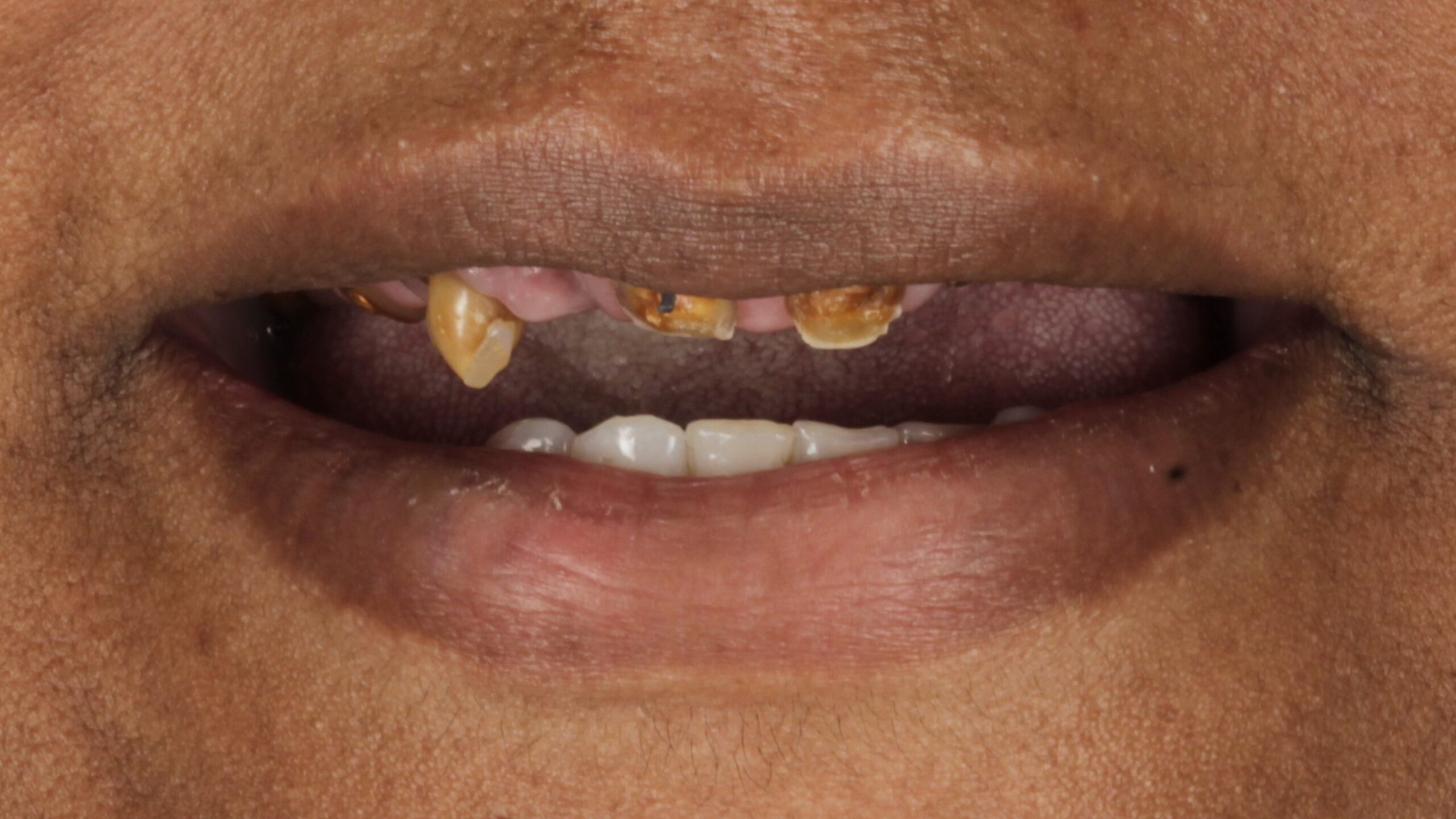 Case 43, single-arch All-on-4: smile before treatment by prosthodontist Dr. Esam Nahlah, Northern Virginia